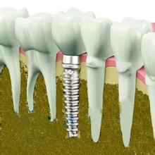 牙齿缺失选择哪种种植牙治疗？