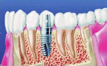 牙齿缺失选择哪种种植牙治疗？