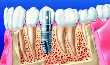 前牙掉了种植牙哪种技术好呢？