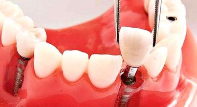 在合肥前牙缺失做什么种植系统好？