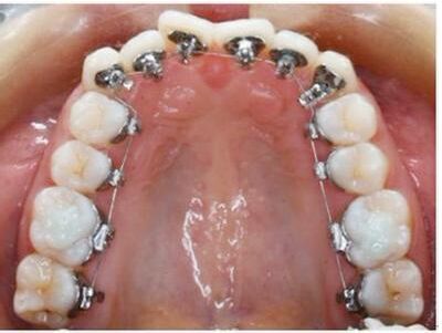 预防牙齿不齐的方法有哪些？