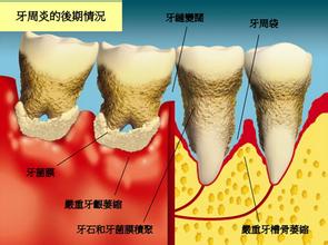 牙齿疾病该如何治疗呢？