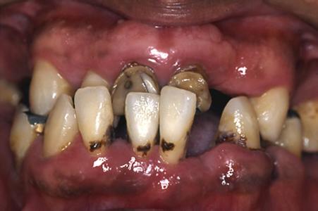 牙周脓肿应该怎么治疗呢？