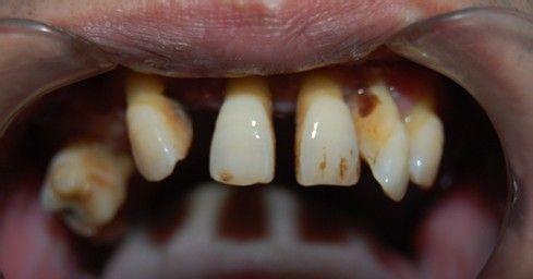 牙齿疾病危害你知道多少？