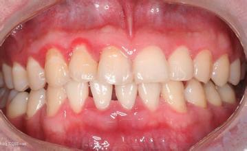 牙龈出血到底是怎么回事？