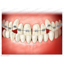 做牙齿矫正的时候会有什么不良反应？